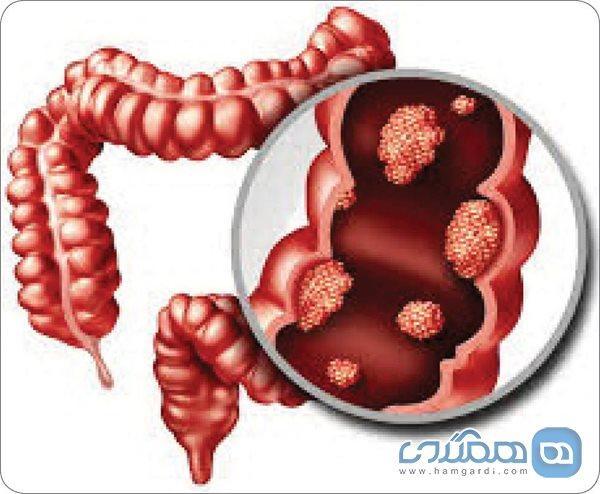 شخصی سازی درمان سرطان روده برای هر بیمار شخصی سازی درمان سرطان روده برای هر بیمار